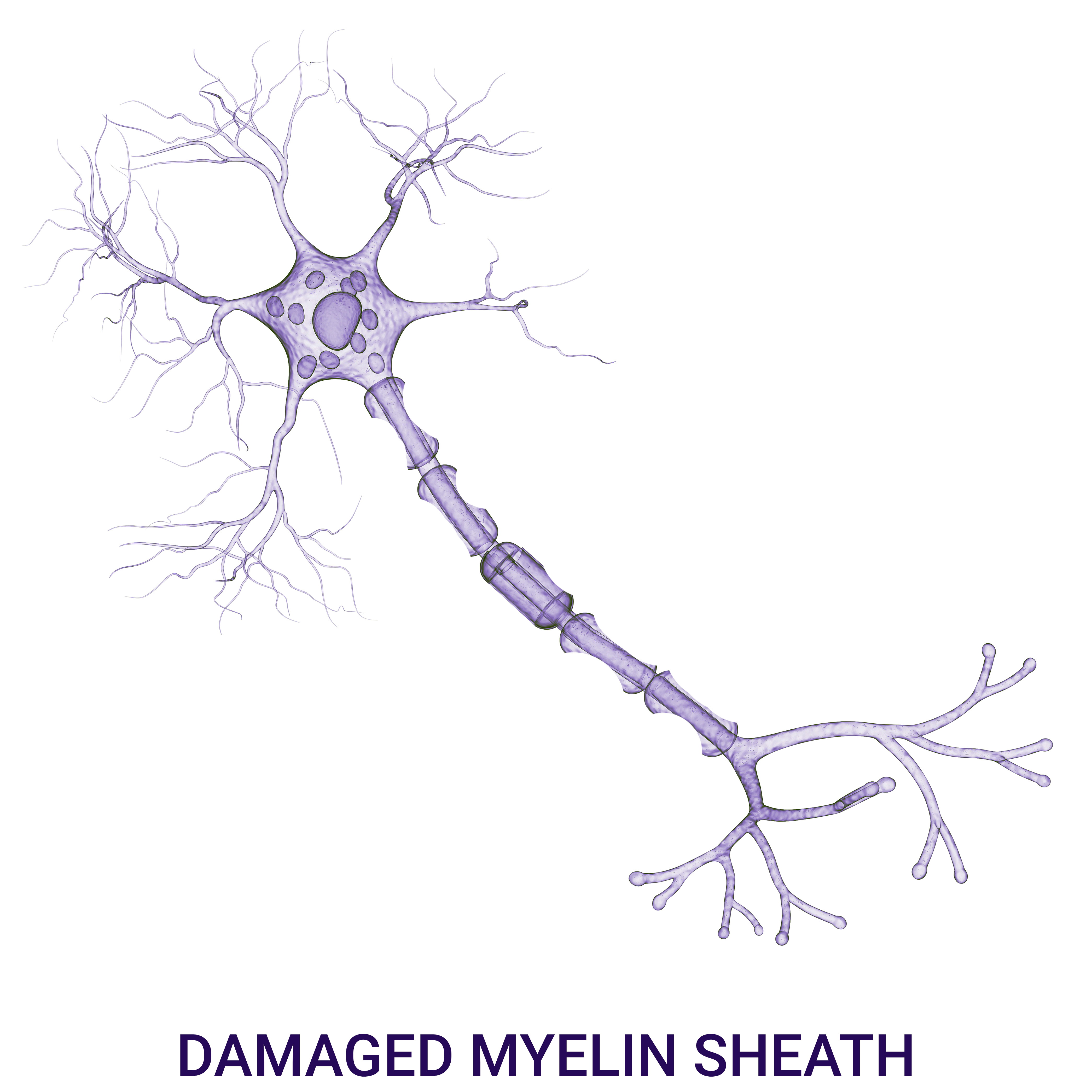 depction of damaged myelin sheath